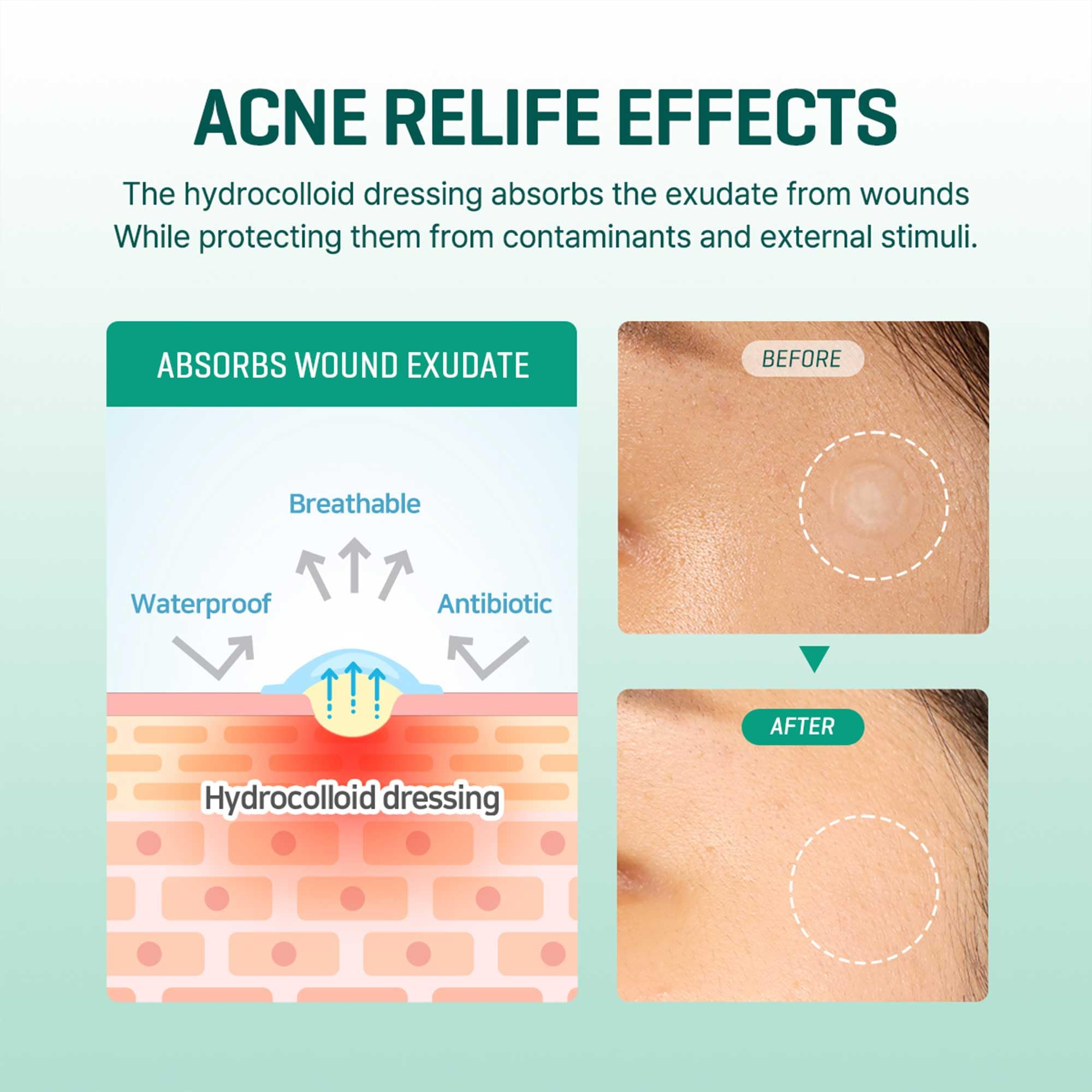 SOME BY MI 30 Days Miracle Clear Spot Patch - Pack of 5, 90 Counts, 2 Size(10mm 45Counts, 12mm 45Counts) - Invisible Hydrocolloid Skin Trouble and Pimple Patch with No Irritation - Korean Skin Care - Image 5