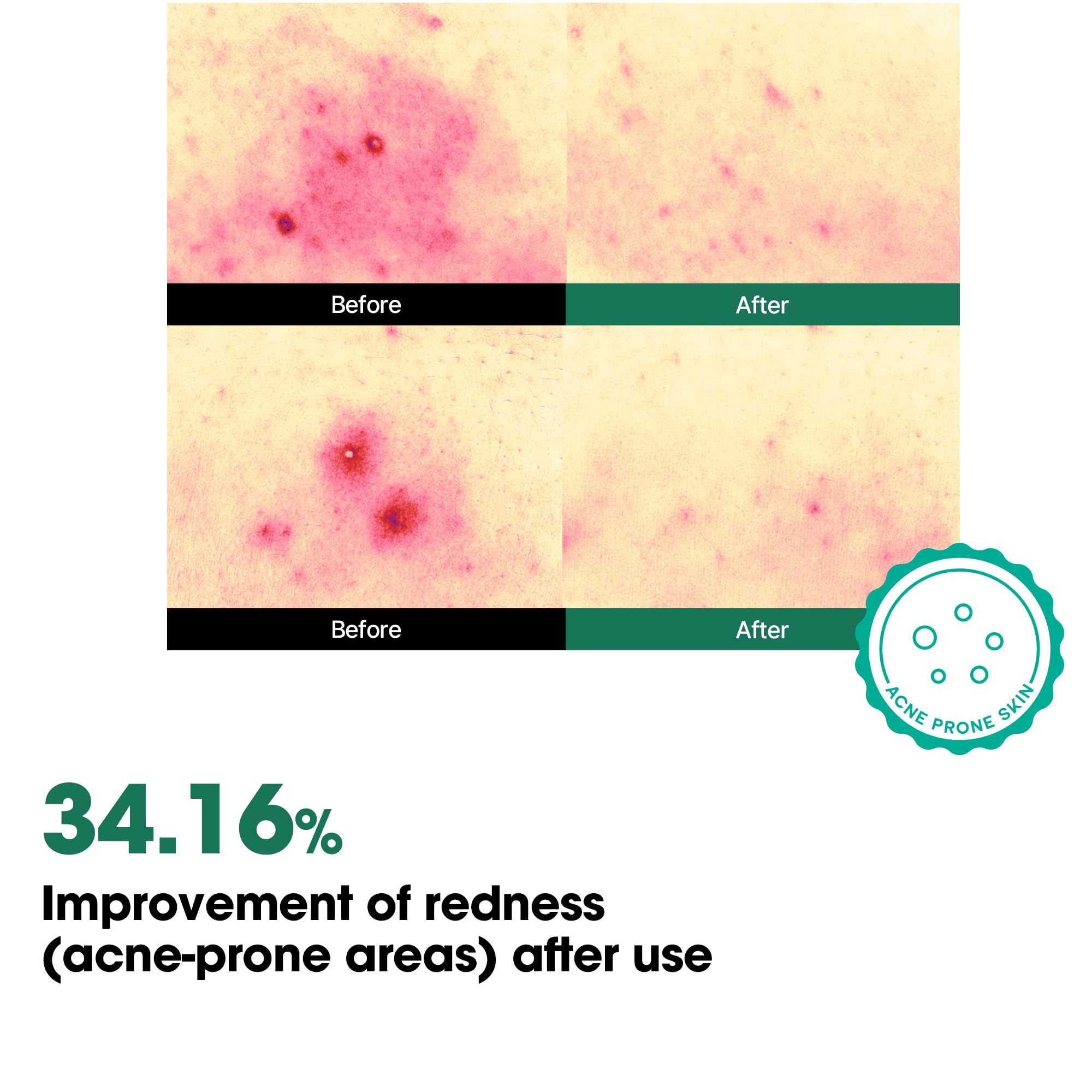 SOME BY MI AHA BHA PHA 30 Days Miracle Body Toner Mist – 4.73oz, 140ml – Body Acne Spray for Back & Chest, Exfoliating Body Mist with Salicylic Acid, Tea Tree, Niacinamide – Korean Skincare - Image 7