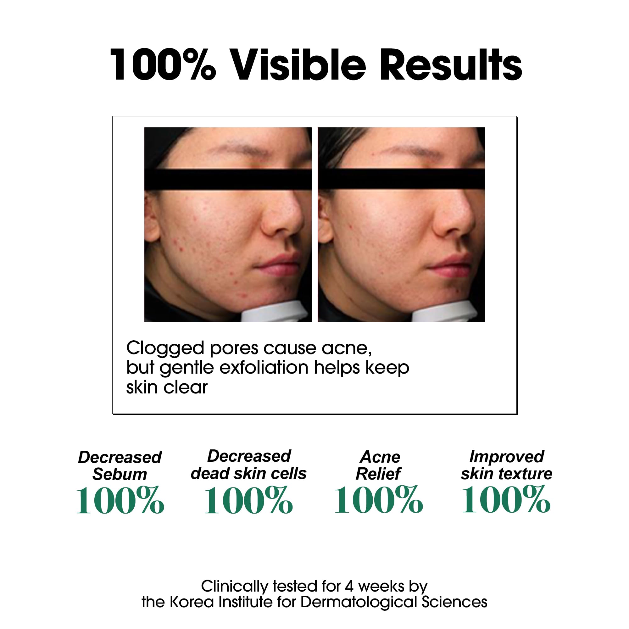 SOME BY MI AHA BHA PHA 30 Days Miracle Toner – 5.07oz, 150ml – Korean Salicylic Acid Exfoliating Face Toner for All Skin Types – Daily Pore Care & Oil Control with 2% Niacinamide – Korean Skin Care - Image 4